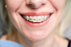 What is the age limit for braces?