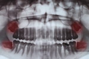 What is an Impacted Wisdom Tooth?